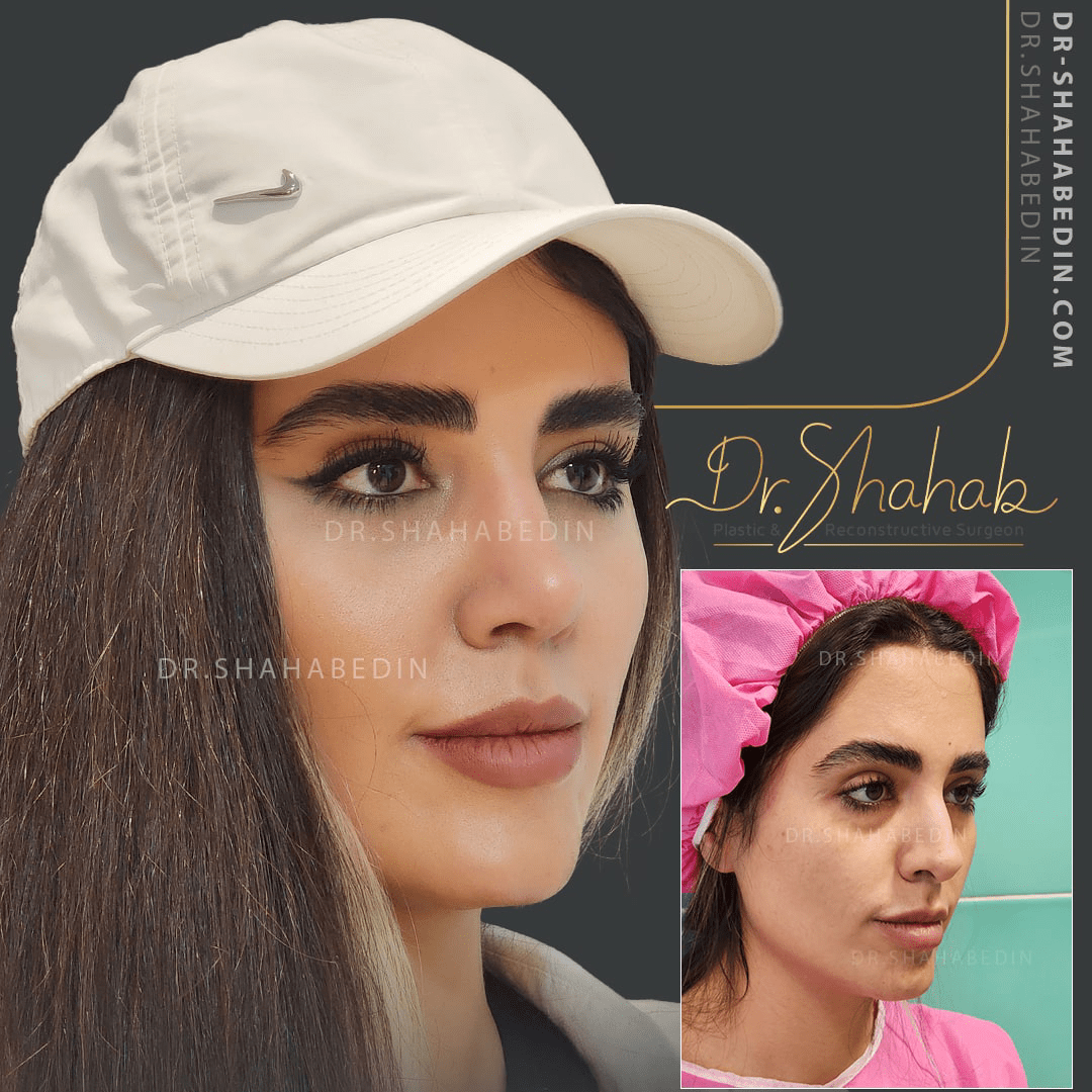 جراحی بینی