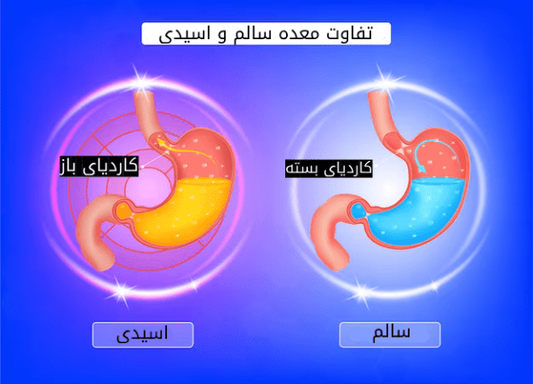 رفلاکس معده چیست؟ 