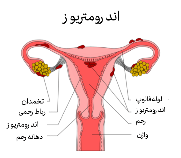 آندرومتریوز چیست؟ 