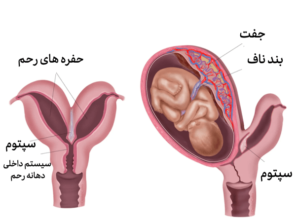 رحم دوشاخ چیست؟ 