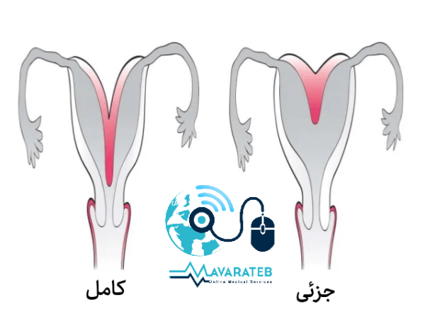 رحم دوشاخ چیست؟ 