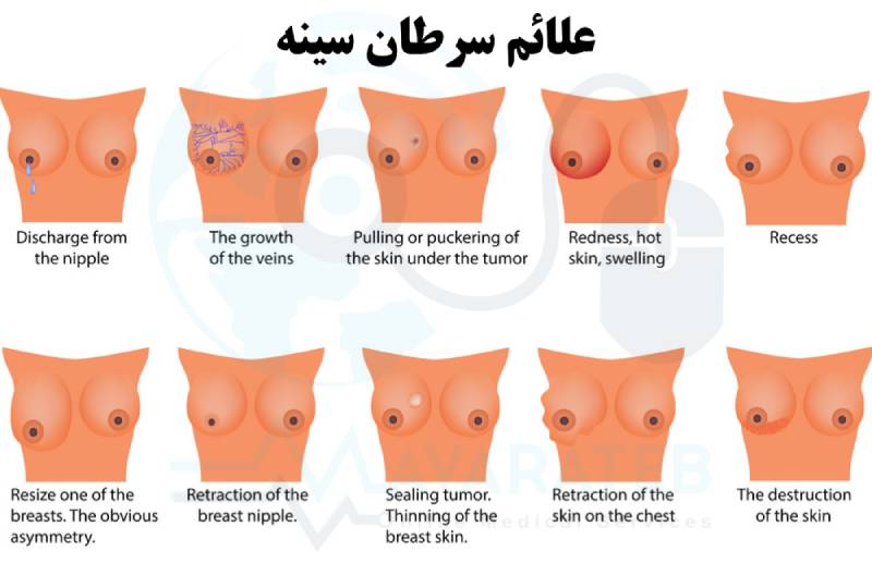 علائم سرطان سینه بدخیم 