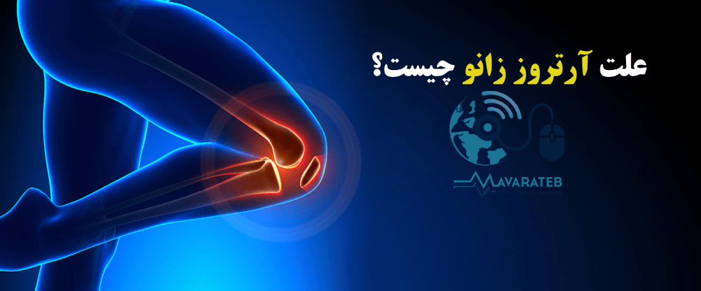 علائم آرتروز زانو 