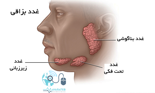 درمان سنگ بزاقی بدون جراحی 