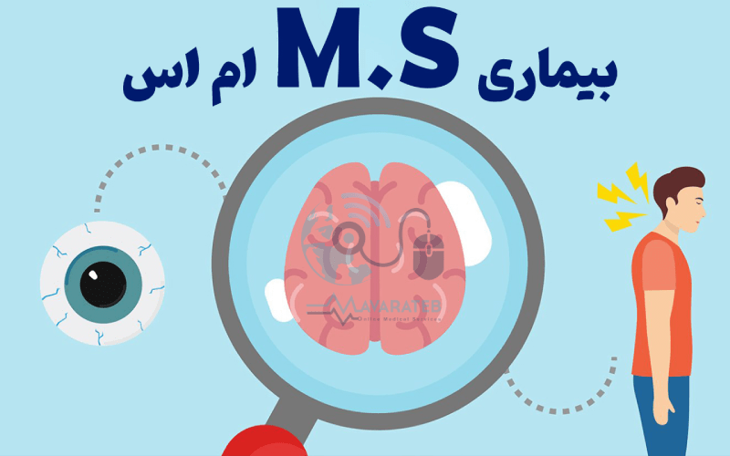 علائم ام اس در زنان 