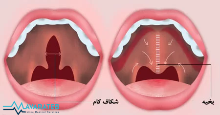 علت شکاف کام در جنین 