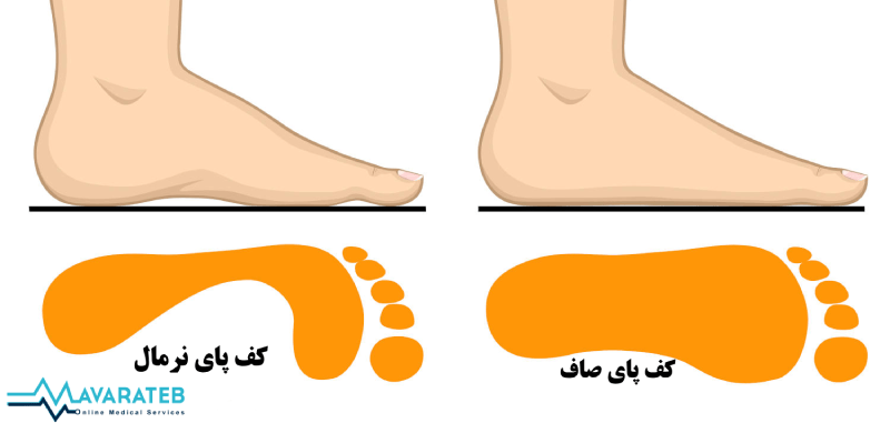 درمان صافی کف پا در نوجوانان 