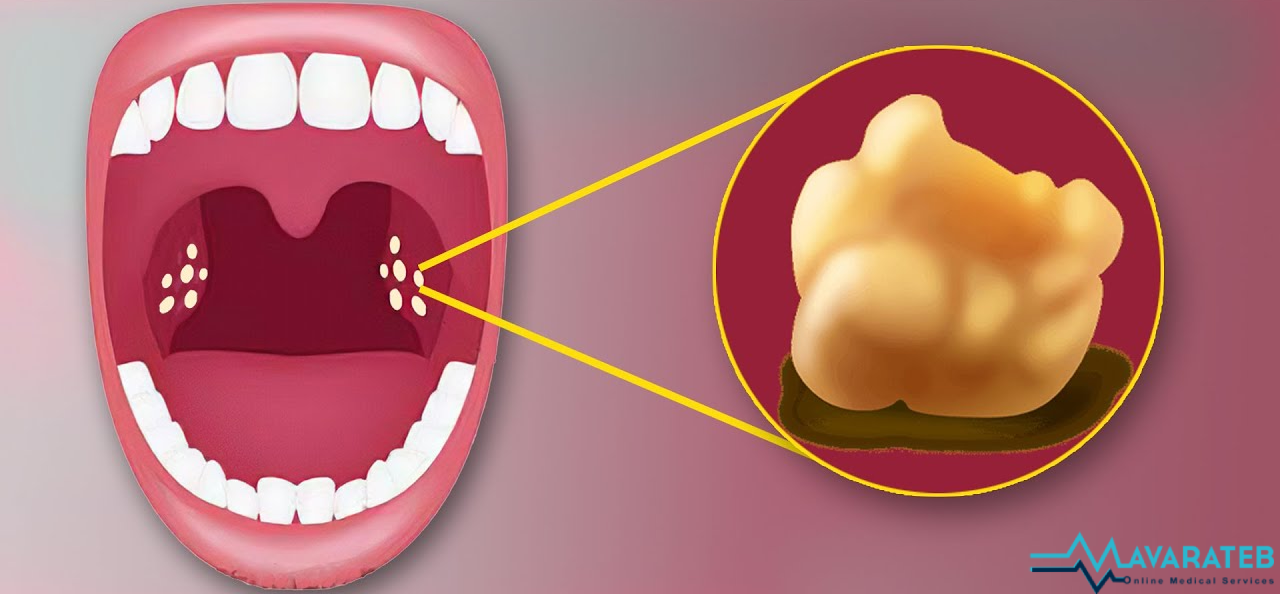 علائم سنگ لوزه 