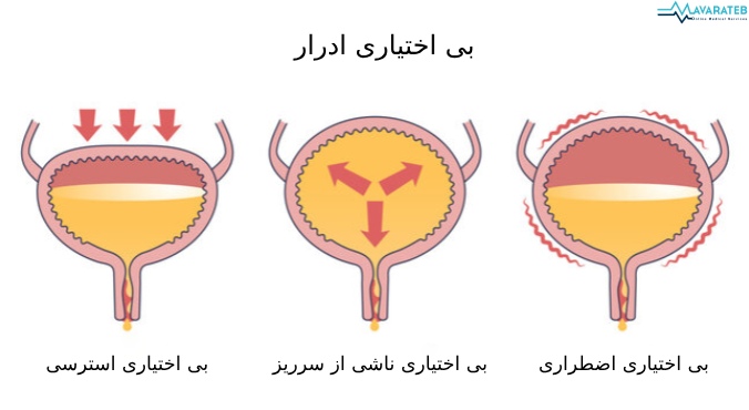 بی اختیاری ادرار 